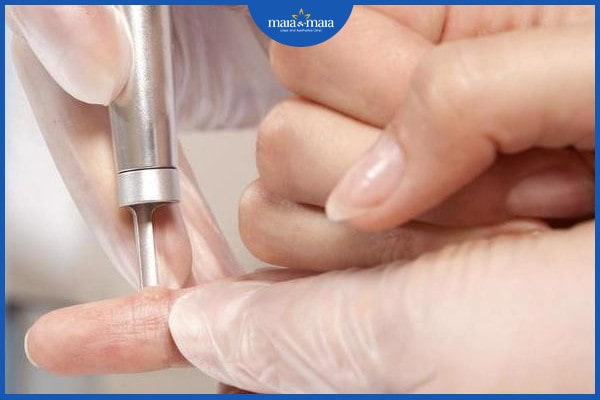 dấu hiệu của mụn cóc
