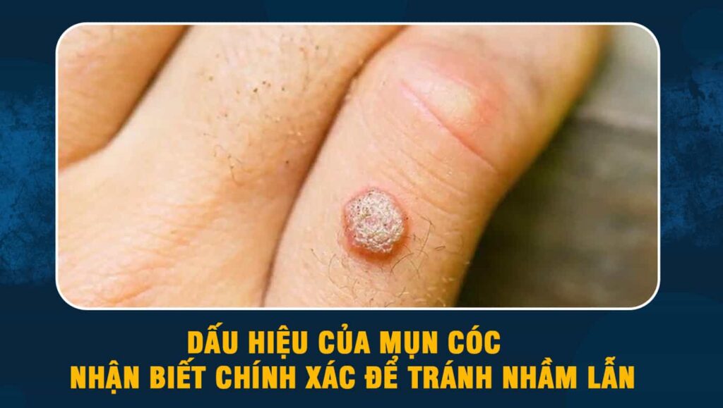 dấu hiệu của mụn cóc