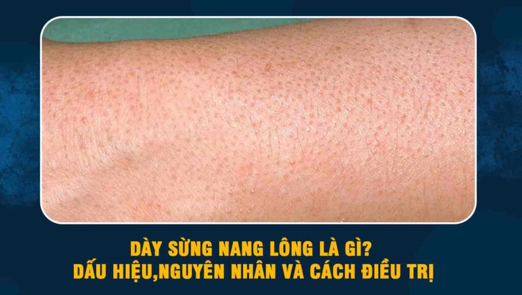 Dày sừng nang lông