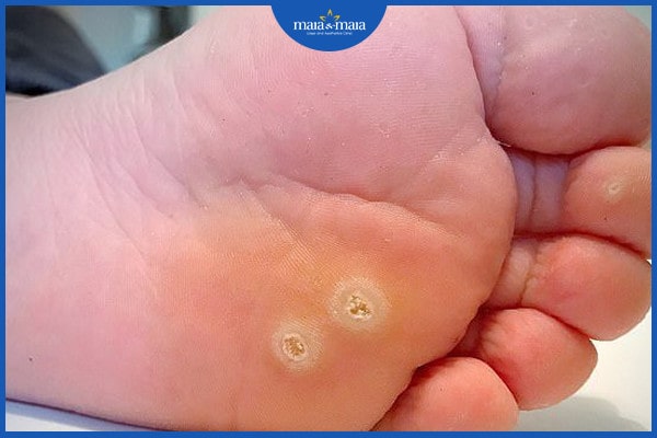 Mụn cóc có tự rụng không