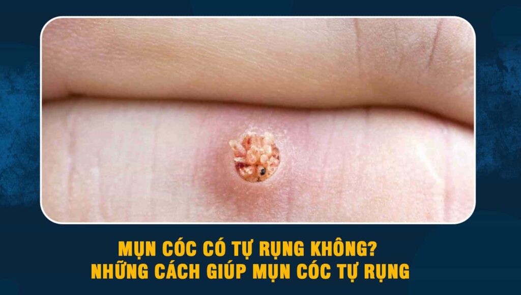 Mụn cóc có tự rụng không