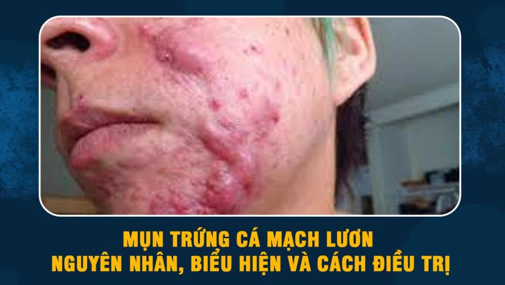 mụn trứng cá mạch lươn