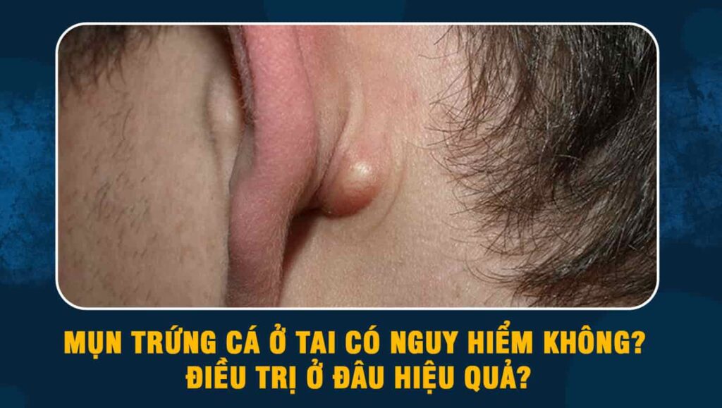 Mụn trứng cá ở tai