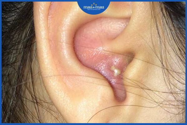 Mụn trứng cá ở tai