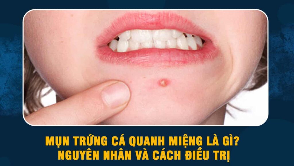 Mụn trứng cá quanh miệng