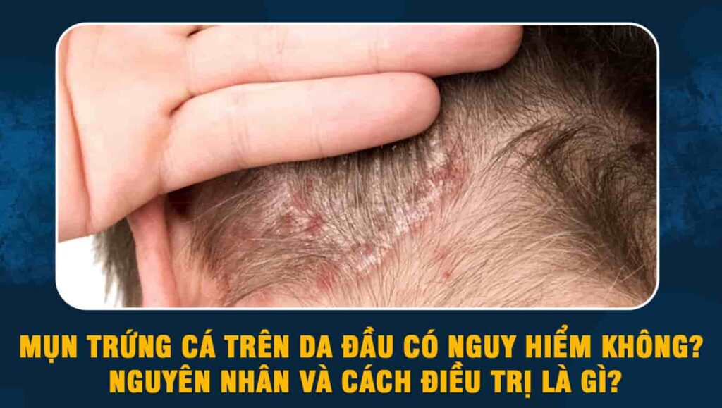 Mụn trứng cá trên da đầu