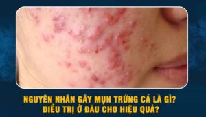 nguyên nhân gây mụn trứng cá