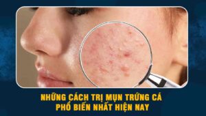 những cách trị mụn trứng cá