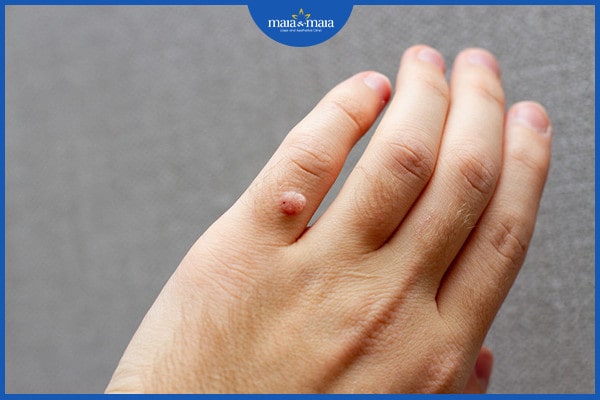 Trị mụn cóc bằng hành tím