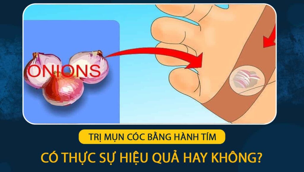 Trị mụn cóc bằng hành tím
