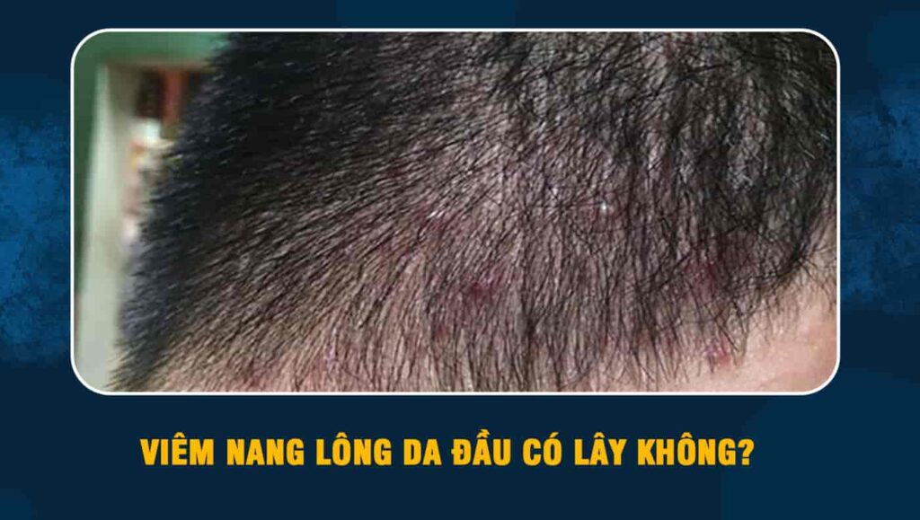 Viêm nang lông da đầu có lây không