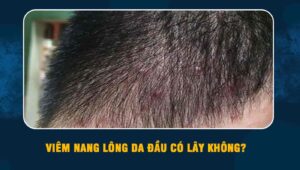 Viêm nang lông da đầu có lây không