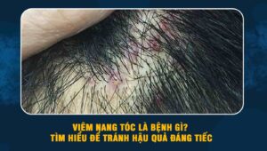 Viêm nang tóc là bệnh gì