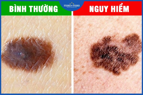 Các loại nốt ruồi