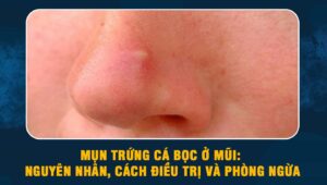 Mụn trứng cá bọc ở mũi