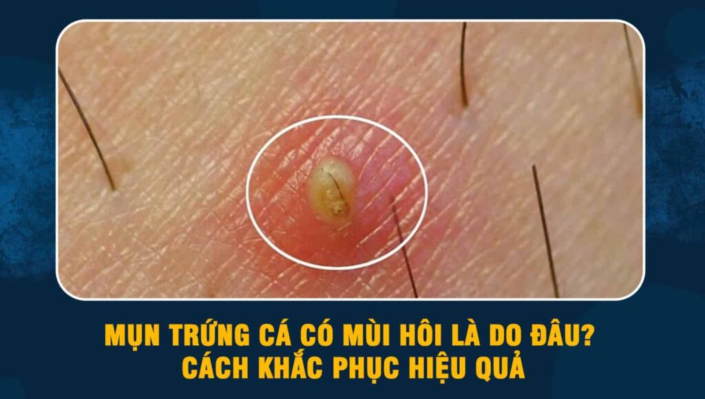 mụn trứng cá có mùi hôi