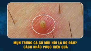 mụn trứng cá có mùi hôi