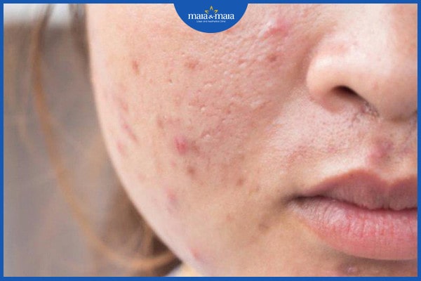 Mụn trứng cá có tự khỏi