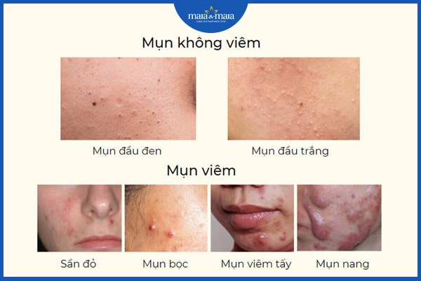 Mụn trứng cá L70