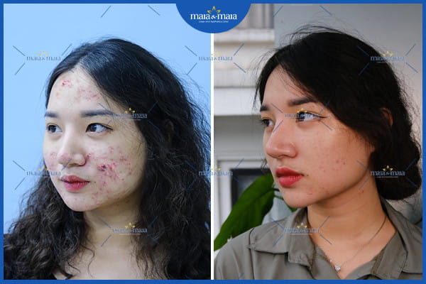 Mụn trứng cá L70