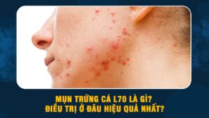 Mụn trứng cá L70