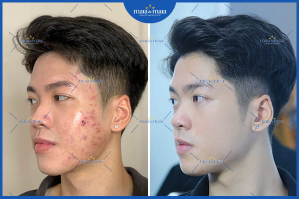 Mụn trứng cá ở nam giới