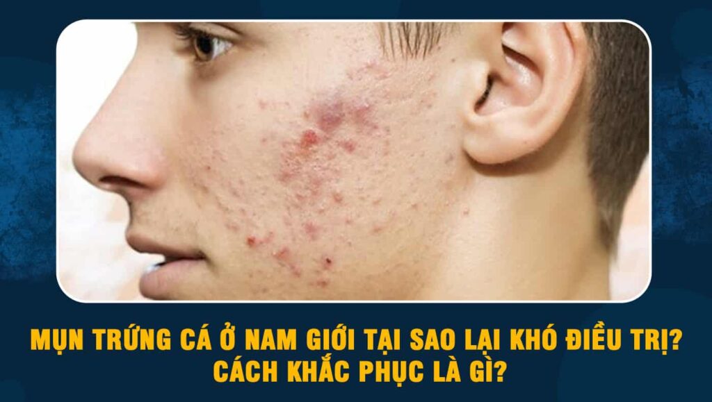 Mụn trứng cá ở nam giới