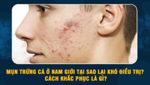 Mụn trứng cá ở nam giới