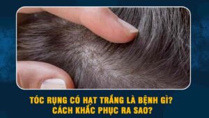 Tóc rụng có hạt trắng