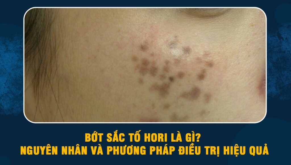 Bớt sắc tố Hori