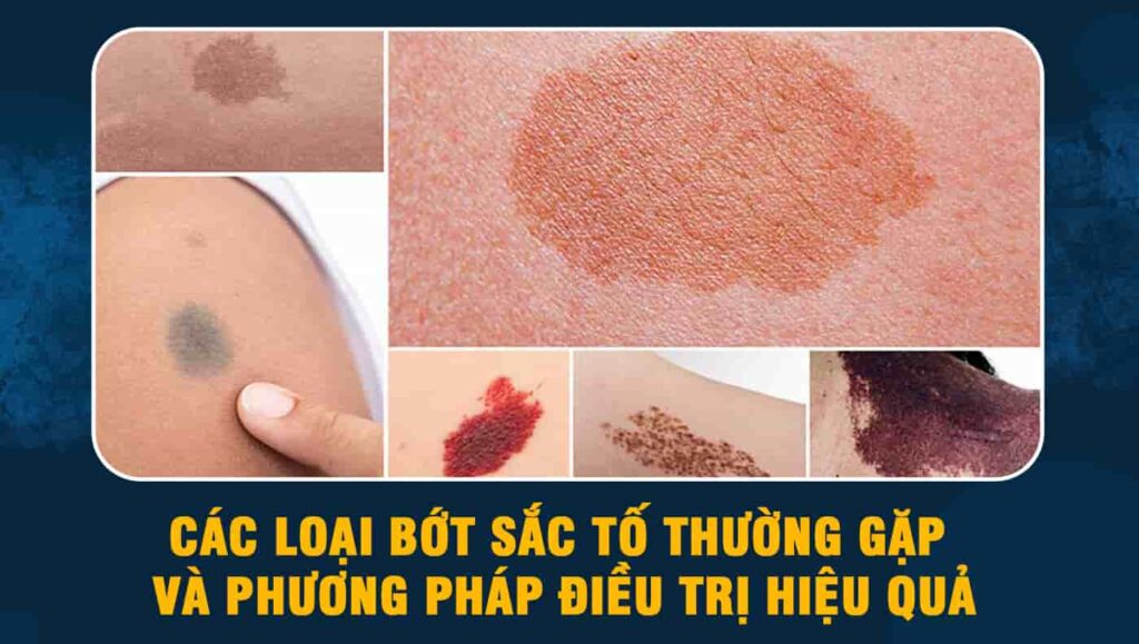 các loại bớt sắc tố
