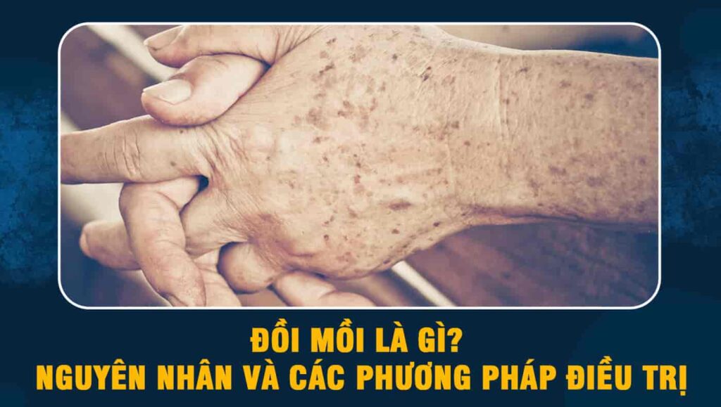 đồi mồi