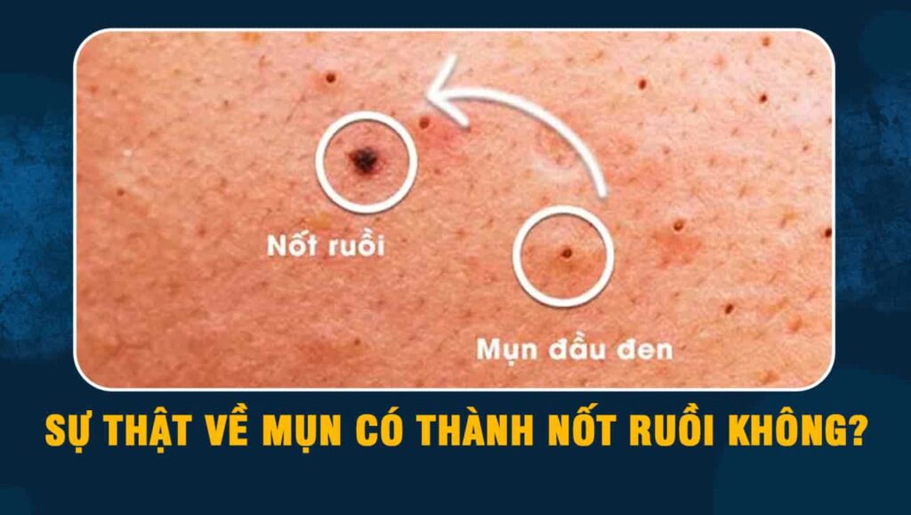 Mụn có thành nốt ruồi không