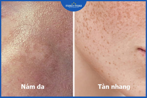 nám và tàn nhang