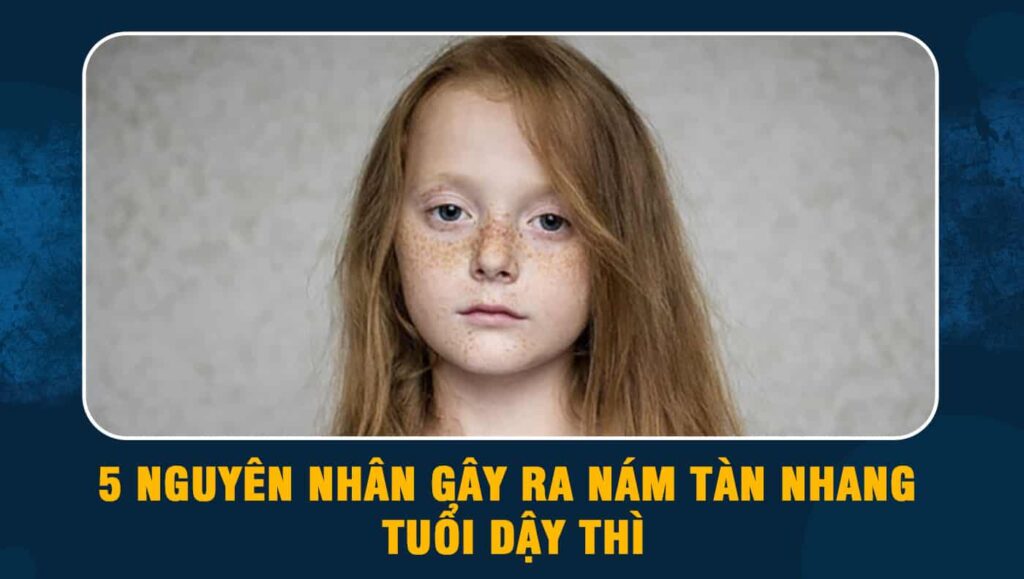 tàn nhang tuổi dậy thì