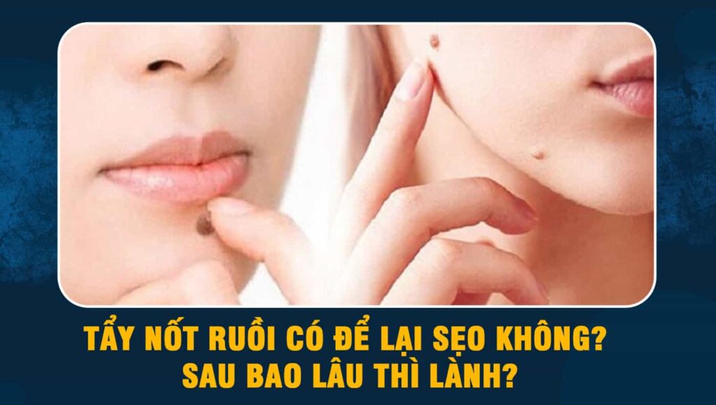 Tẩy nốt ruồi có để lại sẹo không
