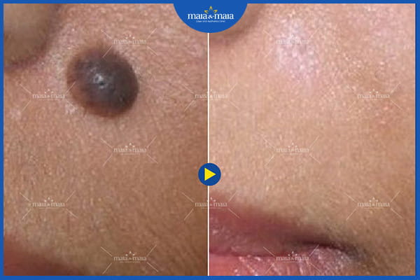 Tẩy nốt ruồi có để lại sẹo không