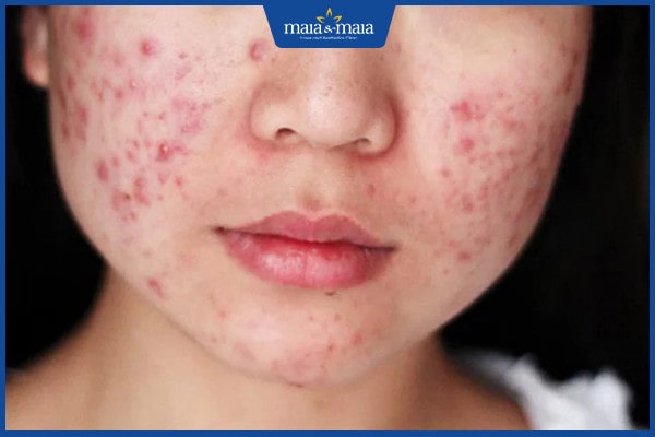 30 tuổi vẫn bị mụn