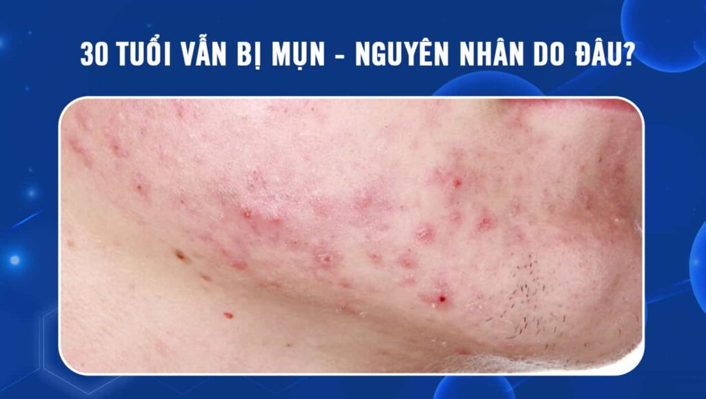 30 tuổi vẫn bị mụn