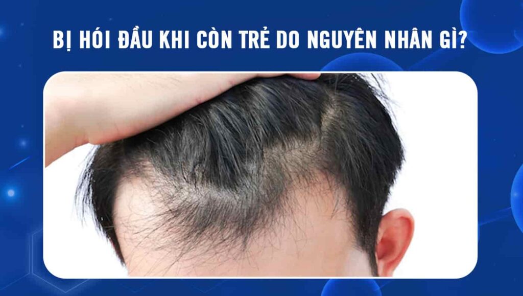 bị hói đầu khi còn trẻ