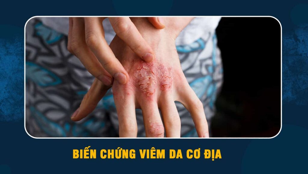 biến chứng viêm da cơ địa