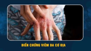 biến chứng viêm da cơ địa