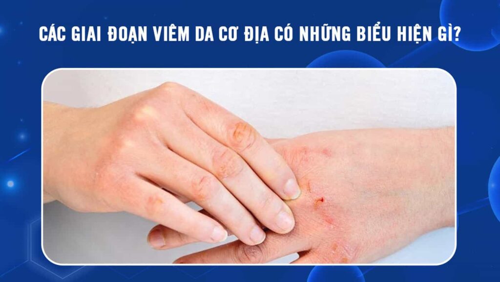 các giai đoạn viêm da cơ địa