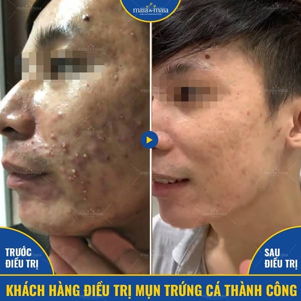 mụn ở từng độ tuổi