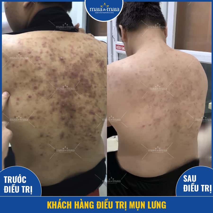 mụn ở từng độ tuổi