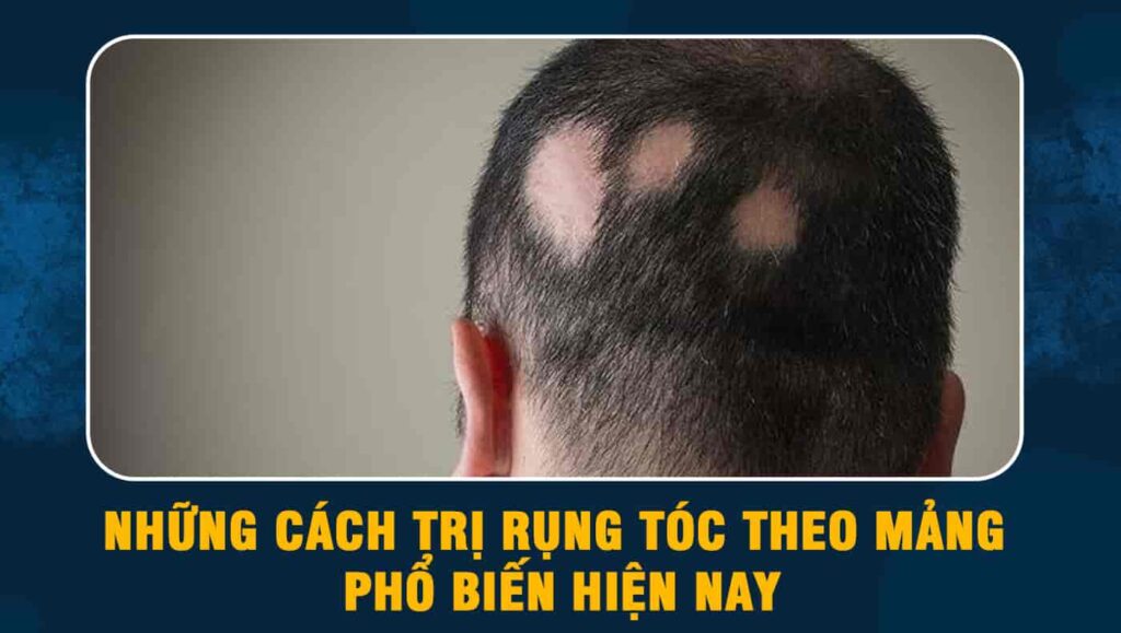 Những cách trị rụng tóc theo mảng