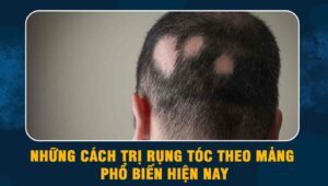 Những cách trị rụng tóc theo mảng