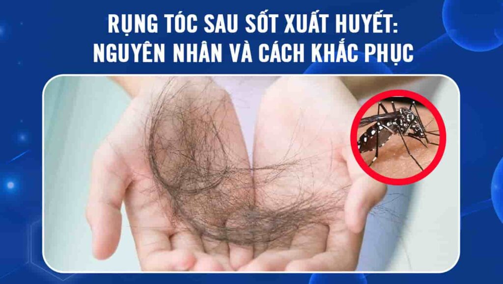 rụng tóc sau sốt xuất huyết