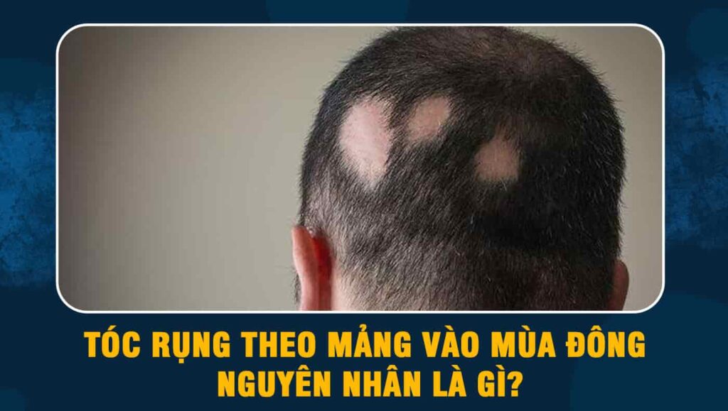 tóc rụng theo mảng vào mùa đông