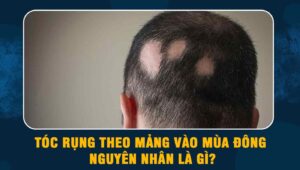 tóc rụng theo mảng vào mùa đông